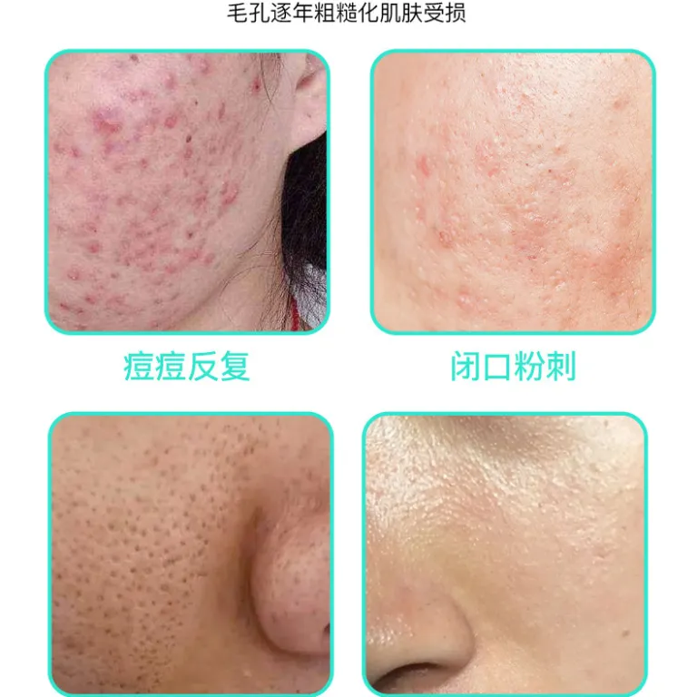 ژل پاک‌کننده منافذ با آزلائیک اسید 15% و سالیسیلیک اسید، کرم مرطوب‌کننده و لایه‌بردار، ماسک از بین برنده جوش سرسیاه