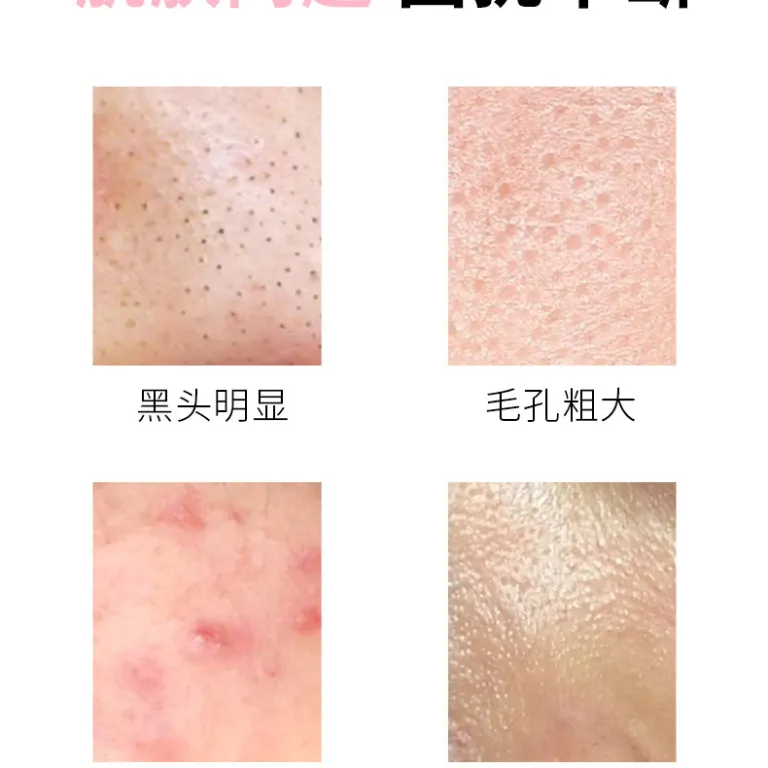 ژل پاک‌کننده منافذ با آزلائیک اسید 15% و سالیسیلیک اسید، کرم مرطوب‌کننده و لایه‌بردار، ماسک از بین برنده جوش سرسیاه